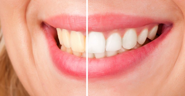 Teeth Whitening